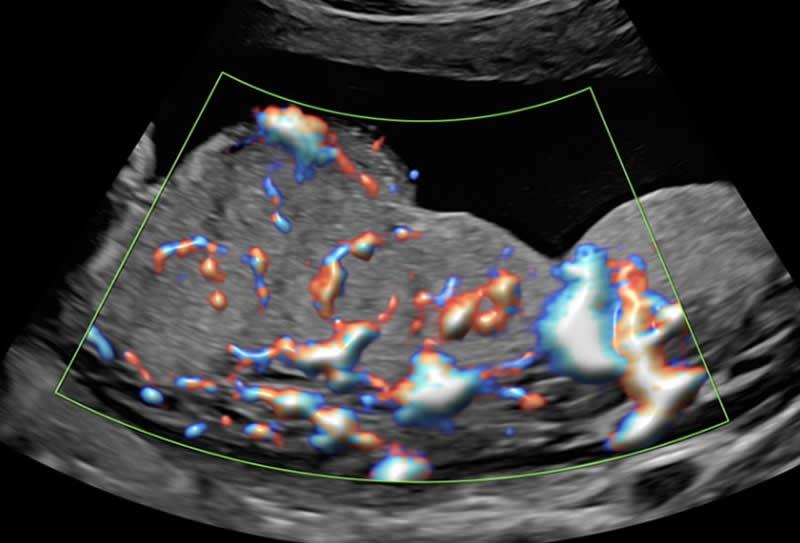 O que é a ultrassonografia com doppler?