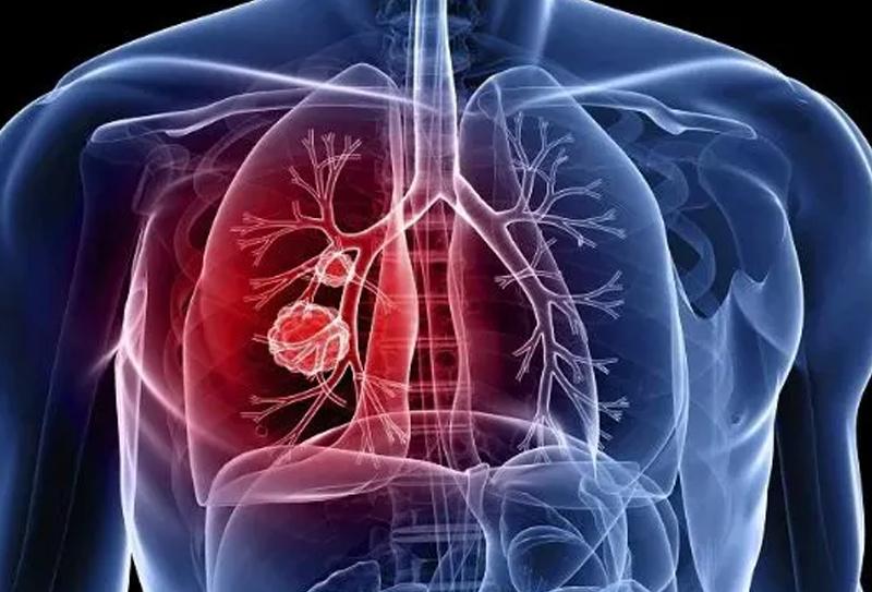 Exame de Imagem para Diagnóstico de Tuberculose