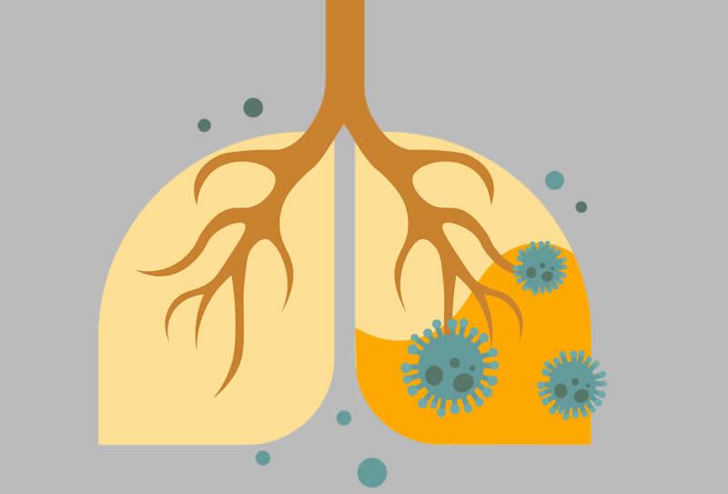Pneumonite: saiba quais são as causas e sintomas