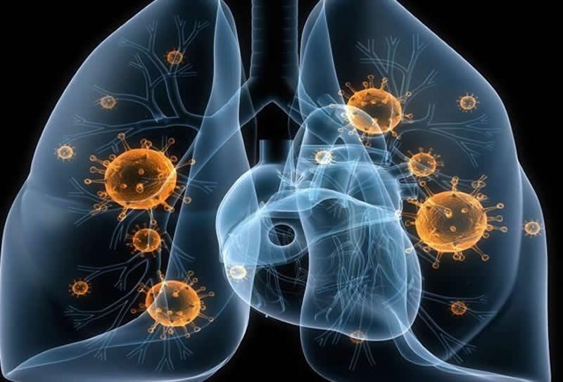 Tuberculose: o que é, diagnóstico e exame