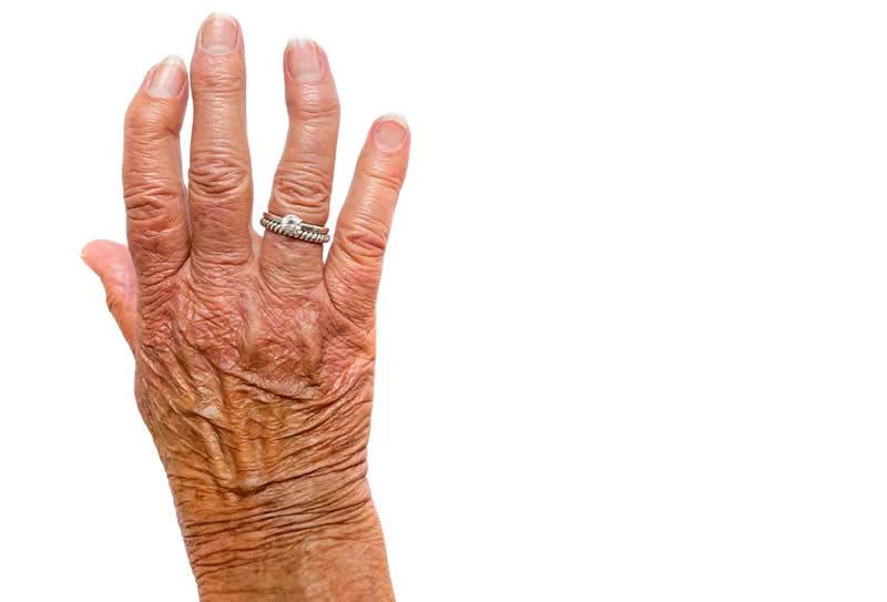 Artrite e artrose: conheça suas diferenças