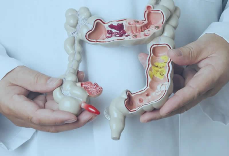 Câncer colorretal: sintomas e sinais de alerta