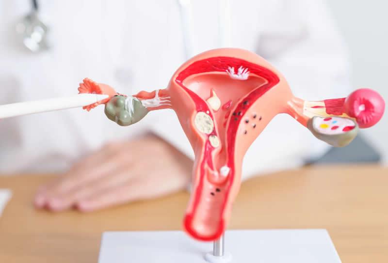 Diagnóstico síndrome dos ovários policísticos